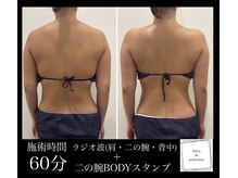 サロン ド パーフェクション(Salon de Perfection)/BODYスタンプ　ラジオ波