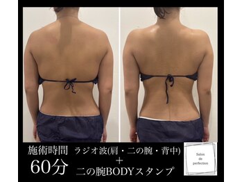 サロン ド パーフェクション(Salon de Perfection)/BODYスタンプ　ラジオ波
