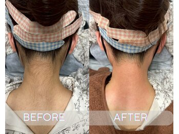 サロン ラズリ 久留米店(SALON Lazuli)/【うなじ脱毛】before/after
