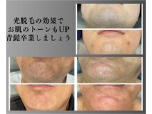 ボゴス 天白店(BOGOSS)/【ヒゲ脱毛】施術写真