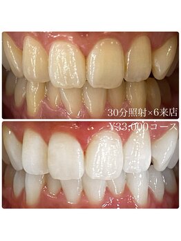 ホワイトニングルーム 横浜店(Whitening Room)/ホワイトニング/横浜