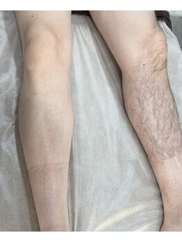 アンシュシュ(UNCHOUCHOU)/脚脱毛(初回来店時の写真です)