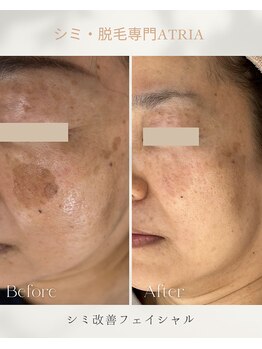 アトリア(ATRIA)/シミ改善フェイシャル