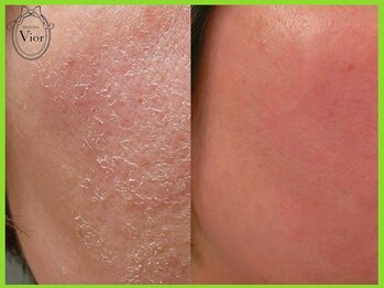 ハーブピーリング 名古屋/1回でここまで効果が出ます！