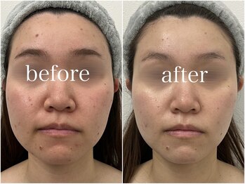 ルテア(Retea.)/REVIハーブピーリング