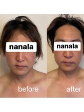 ナナラ(nanala)/小顔フェイシャル