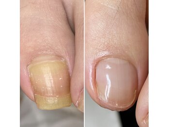 ランカ(RUNKA)/厚い変色したお爪もピカピカに！