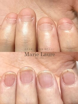 マリーロール 梅田店(Marie Laure)/自爪育成/深爪矯正/ネイルケア