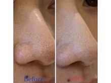 シャルム(Charme)/毛穴ケア♪