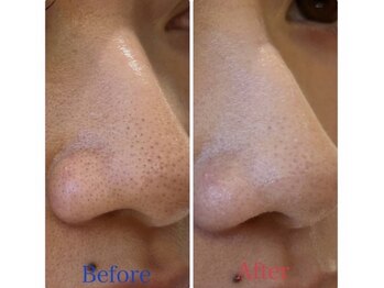 シャルム(Charme)/毛穴ケア♪