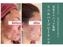 ビレナ 守谷店(Birena)/痛い!高い!でも効果はダントツ！