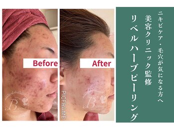 ビレナ 守谷店(Birena)/痛い!高い!でも効果はダントツ!