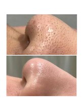 イニジアエリート 池袋店(inizia elite)/毛穴洗浄1回の効果