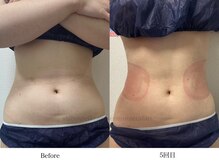 スラリ(SLARI)/【腹部　脂肪冷却】期間1か月半