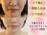 《月5名限定》脱老け見え!固い表情筋ケア◎小顔矯正＋首肩リンパ[頬骨矯正]　