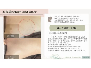 エミルカ 鹿児島店(EMILUCA)/ハーブピーリング