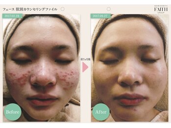 リノア 堀江(Linoa)/7ヶ月半後 before→after