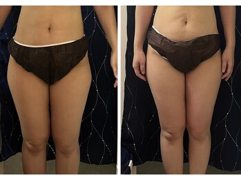 ヨサパーク カラット(YOSA PARK CARAT)/ビフォアーアフター