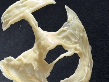 ペティアン レーヴ(PETILLANT reve)の写真/【ヤミツキ人気★フェイスWAX顔脱毛】産毛までスッキリ!!もちもちスベスベのお肌が現れる♪毛穴引き締め◎