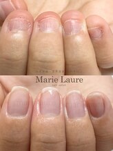 マリーロール 梅田店(Marie Laure)/深爪矯正/自爪育成/自爪風