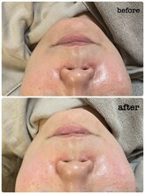 ニコリ(Nicori)/フェイシャルシェービングエステ