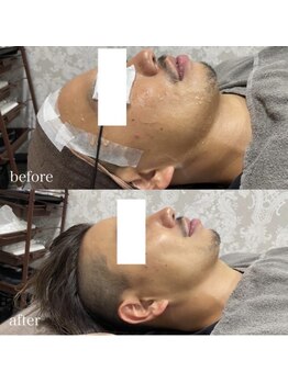 ホッコリ 段原店(HOKKORI)/効果実感No.1BBL光フェイシャル