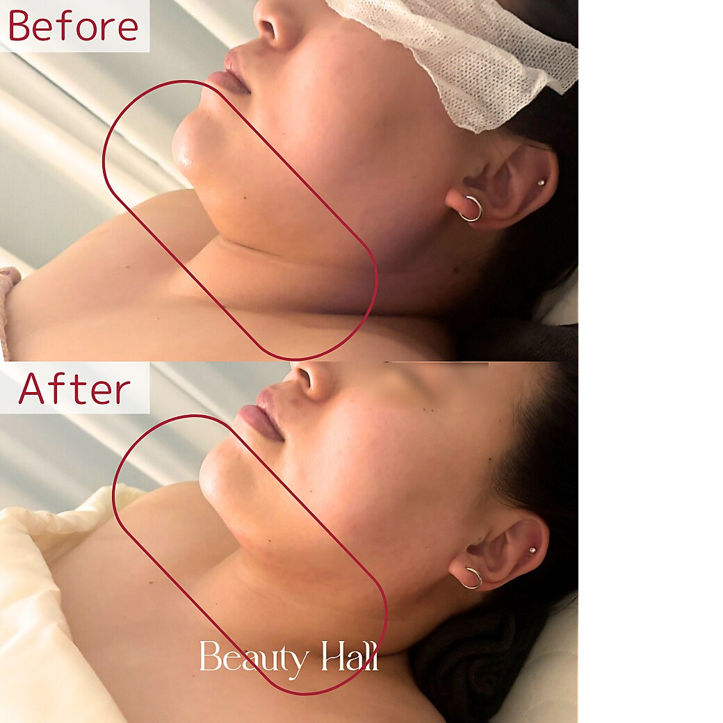 ラジオ波 キャビテーション ポレーションに関するサロン Beauty salon