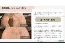 エミルカ 鹿児島店(EMILUCA)/ハーブピーリング