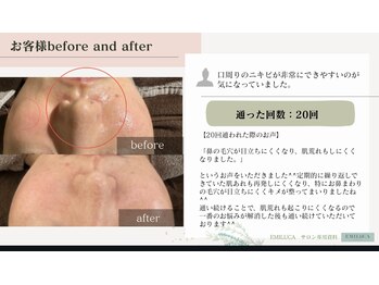 エミルカ 鹿児島店(EMILUCA)/ハーブピーリング