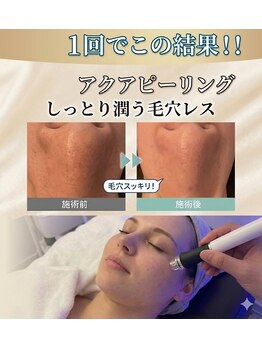玉響(Tamayura)の写真/美肌の基本は毛穴レス☆アクアピーリングや高濃度炭酸カーボキシーで毛穴汚れを除去＆引き締め！