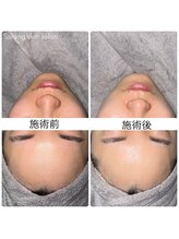 サラン スキンサロン(Sarang skin salon)/川西｜毛穴洗浄 リフトアップ
