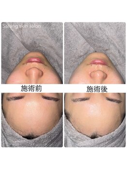 サラン スキンサロン(Sarang skin salon)/川西｜毛穴洗浄 リフトアップ