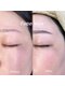 ユーアイ(Yu_eye)の写真/《ツヤ肌WAX脱毛★全顔1回¥6000~》明るく均一な肌トーンで素肌に自信を＊お得な眉WAXとのSETメニューも◎