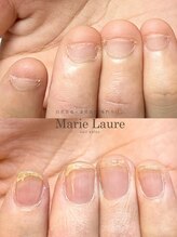 マリーロール 梅田店(Marie Laure)/自爪育成/深爪矯正/ネイルケア