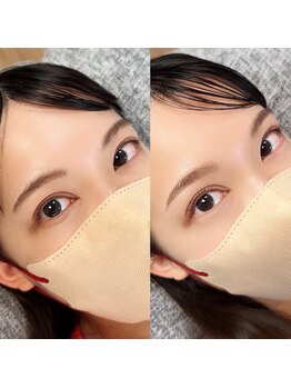 リノ リノ(Lino.Lino)/before/after