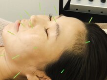 ふじおか鍼灸整骨院/美容鍼でハリ＆リフトアップ！