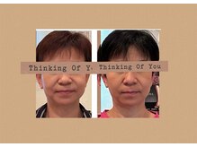 パワーパステル/骨格小顔矯正　6回目after