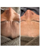 セラピーラボ(Therapy Lab)/【美容】ハイドロエステ2回施術