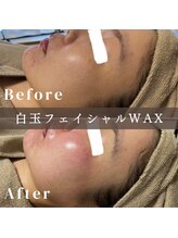 エピナ 横浜店(Epina)/白玉フェイシャルワックス脱毛♪