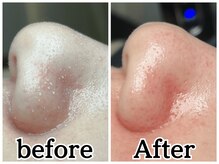 イデアルボーテ/ごっそり毛穴洗浄で素肌美人に☆