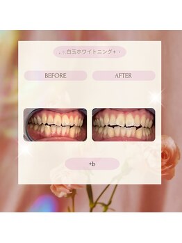 プラスビー 2号店(+b)/ホワイトニングビフォーアフター