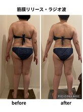 クリア(Clear)/筋膜リリース・ラジオ波