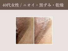 ラウン 京都(ROUN')/1回の施術のビフォーアフター