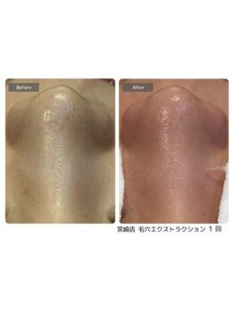 エミルカ 鹿児島店(EMILUCA)/毛穴ケア