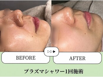 ベネミー 恵比寿(Benemi)/毛穴洗浄/プラズマシャワー