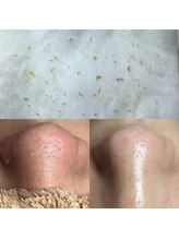 ビューティーネイル(Beauty Nail)/毛穴エクストラクション