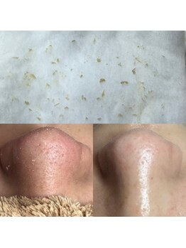 ビューティーネイル(Beauty Nail)/毛穴エクストラクション