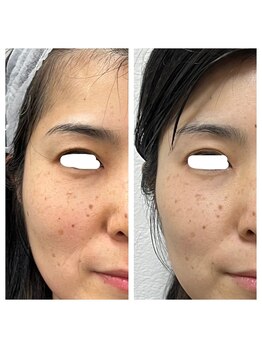 シスタス(Cistus)/ExoLift before after