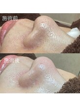 エクラ バイ シャンリィ(eclat by shanLy)/毛穴綺麗