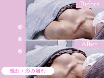 キアナ 横浜店(Kiana)/離れにお悩みの方Before After